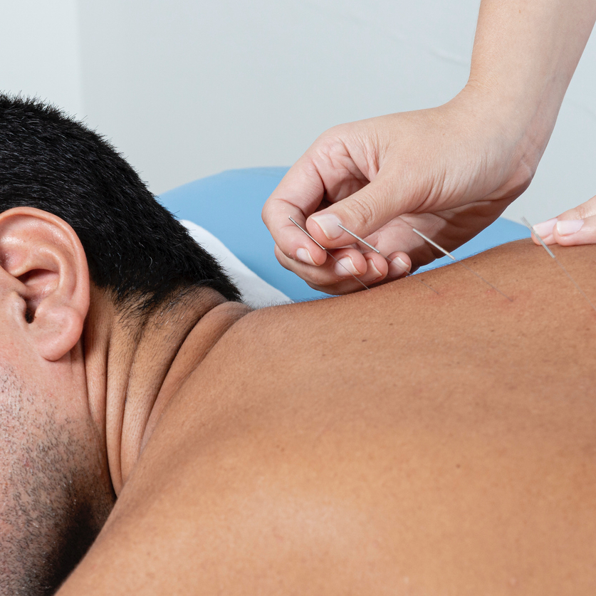 acupuncture